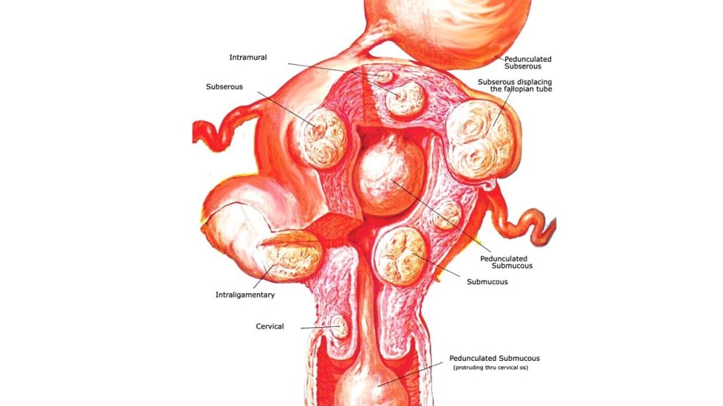 Fibroid surgery safe when done by professionals, say gynaecologists