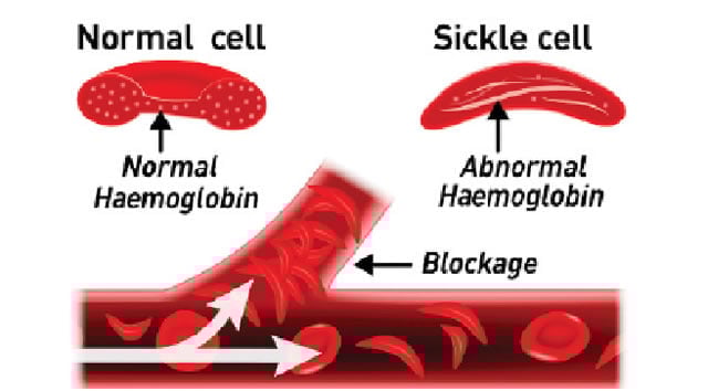 100 sickle cell patients get free NHIA enrolment