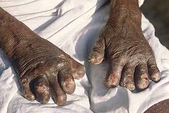 Leprosy patients groan as drug shortage persists for two years — Dermatologists