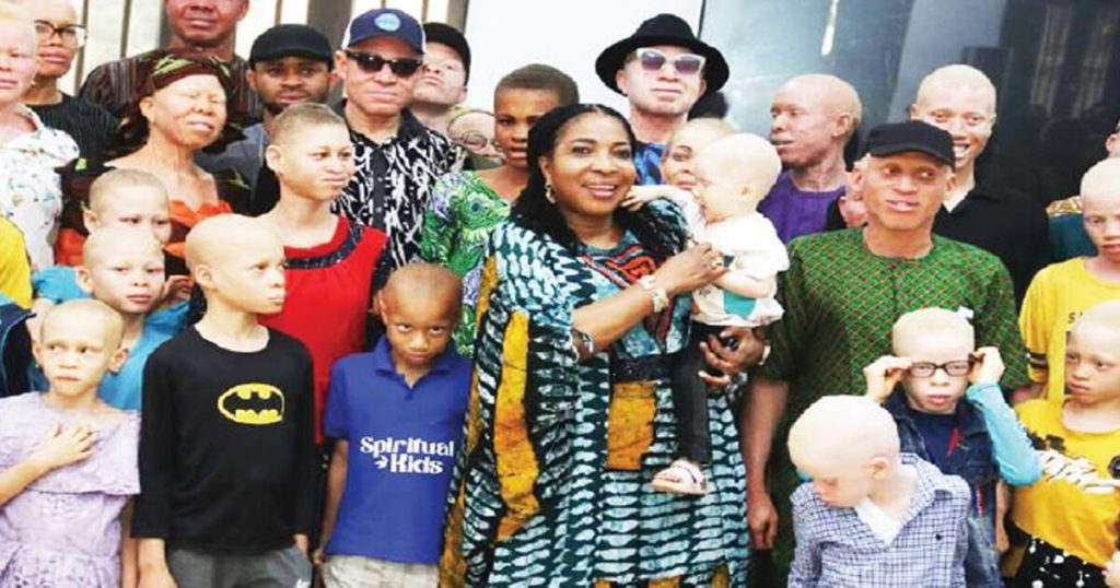 Abia government supports people with albinism & others