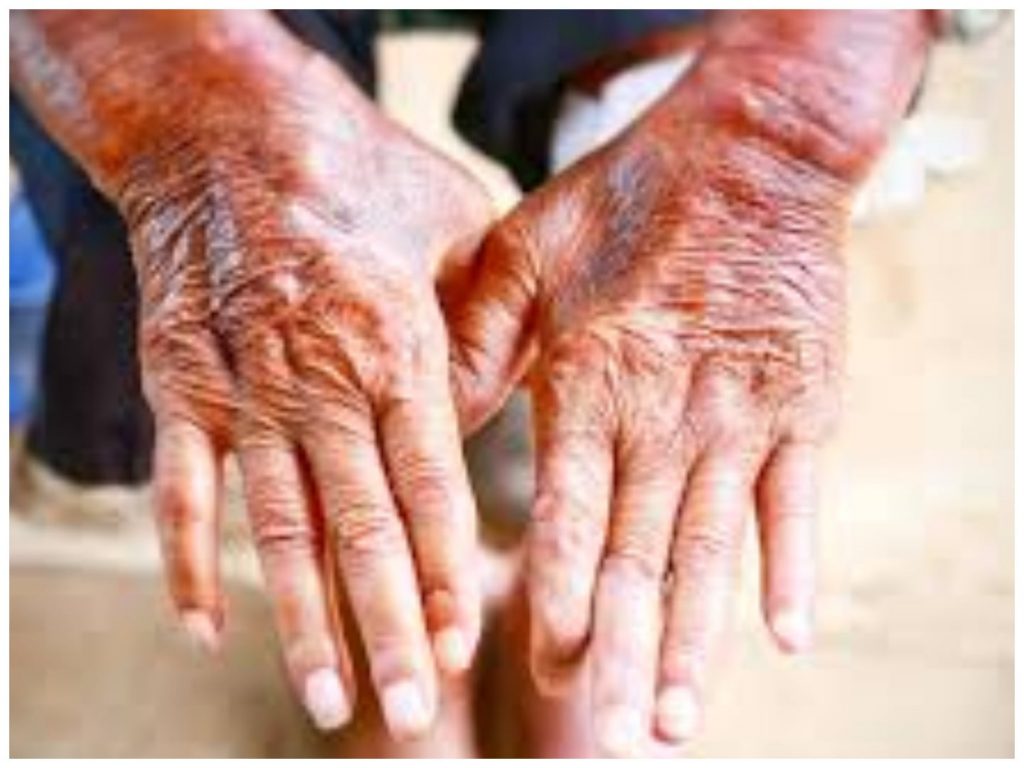 Finger colour changes may be sign of autoimmune disease — Experts